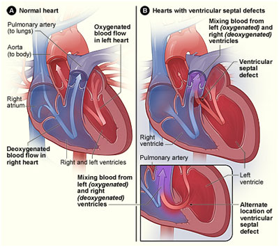 Congenital Heart Defect